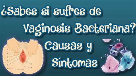 Cómo Evitar La Vaginosis Bacteriana Causas Y Sintomas De La