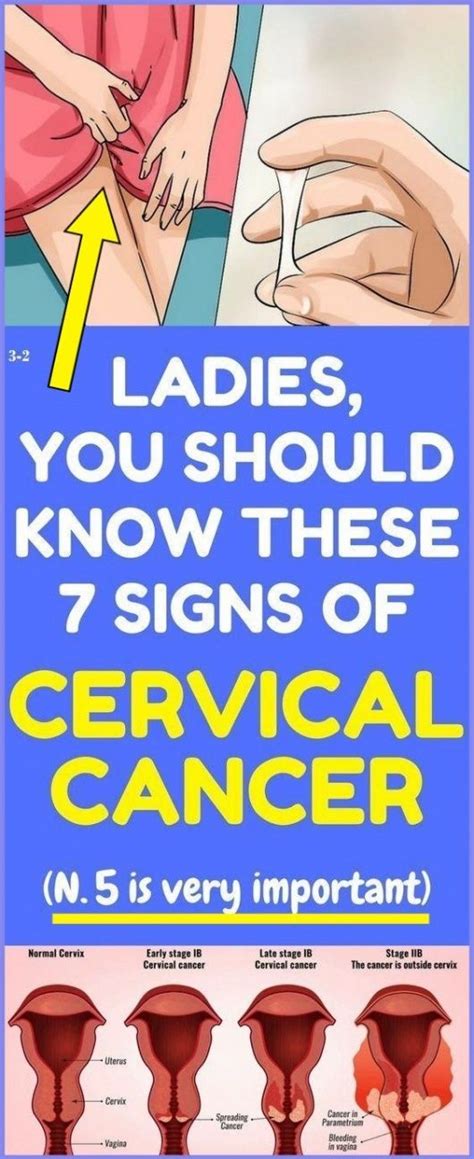 Warning Symptoms Of Cervical Cancer That Every Women Should Know Medicine Health Life