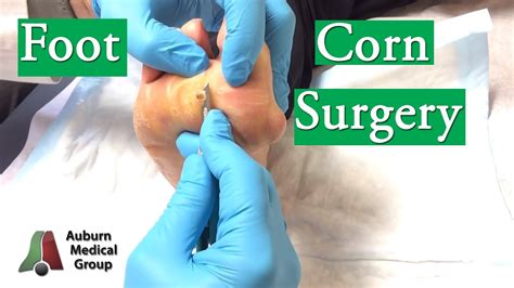 Foot Corn Surgery Treatment Youtube