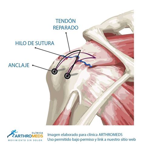 Artroscopia Manguito Rotado Del Hombro Por Rotura De Tendón