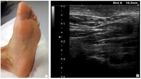 Ledderhoses Disease International Journal Of Clinical And Medical Images