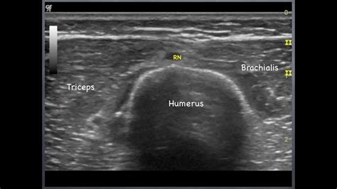 Radial Nerve Humerus To Elbow Sonoanatomy Qmh Aed Ultrasound
