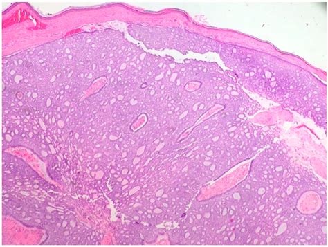 Superficial Basal Cell Carcinoma Histology