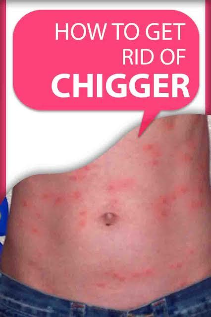 In the meantime, try to. How to Get Rid of Chiggers? How to Treat Chigger Bites?