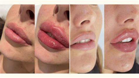 Russian Lip Filler Technique Vs Normal Whats The Difference The