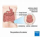Colostomy Medical Definition