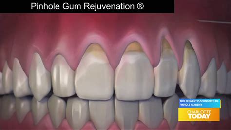 Revolutionary Treatment For Receding Gums