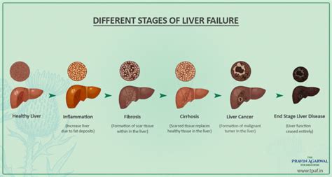 What Are The Different Stages Of Liver Failure