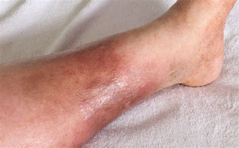 What Is Cellulitis And How Do You Treat It Bass Urgent Care