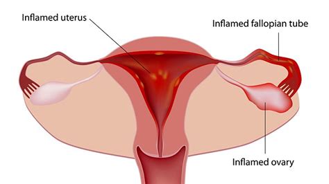 Reasons For Painful Periods And Menstrual Cramps Everyday Health