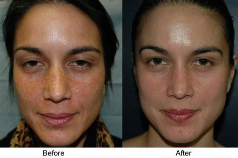 Maybe you would like to learn more about one of these? Before &after results of microdermabrasion with vitamin c ...