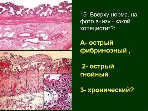 Заболевания и диета желчного пузыря Заболевания печени желчного пузыря и поджелудочной железы Тема Заболевания печени желчного пузыря и поджелудочной железы Тема Заболевания и диета желчного пузыря