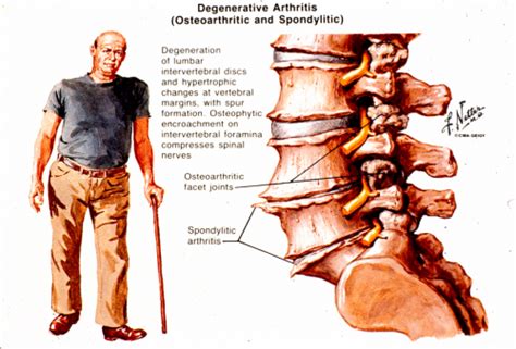 Arthritis Of The Spine Arthritis Treatment