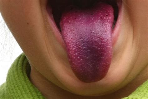7 Warning Signs Your Tongue May Be Sending Natural Home Remedies And Supplements
