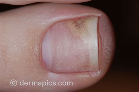 Fungal Nail Infections Onychomycosis Pictures In High Resolution