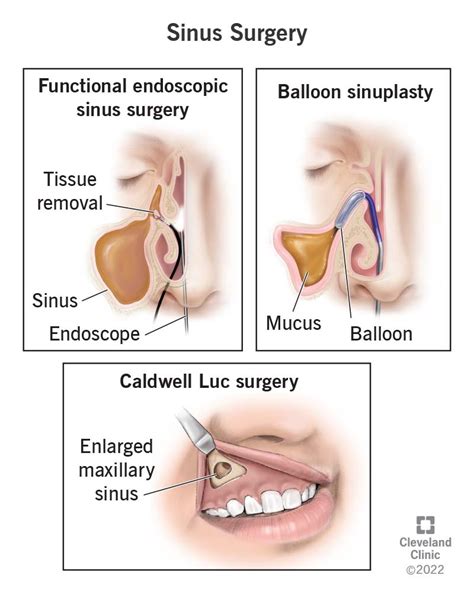 Sinus Surgery Types Procedure And Recovery