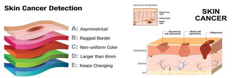 Skin Cancer Detection It Is Important To Check Your Body Regularly
