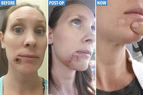 Mum Of Five Left With A Gaping Hole In Her Chin After Dismissing Deadly Skin Cancer For A
