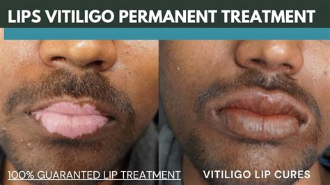 Lip Vitiligo Treatment 100 Guaranteed Vitiligo Lip Cure How To