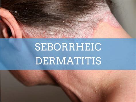 Сhronic Seborrheic Dermatitis Treatment Is It Contagious And Pictures