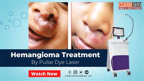 Hemangioma Treatment By Pdl Pulse Dye Laser Pulsed Dye Laser Treats A Variety Of Red Skin