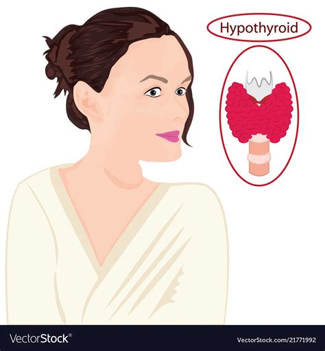 Goiter Enlarged Thyroid Endocrine Disfunction Vector Image