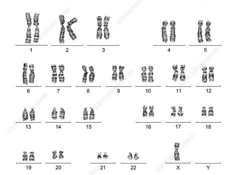 Human Karyotype With Turner Syndrome Stock Image C016 6740