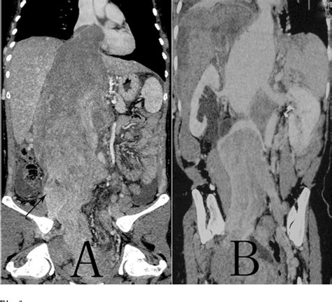 Figure 1 From Giant Intravenous Leiomyomatosis With Intracardiac