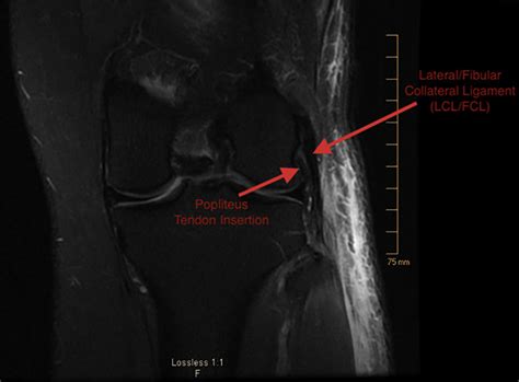 Ligaments are bands of tough elastic tissue around your joints. Magnetic resonance imaging scan showing distal aspect of the left leg's... | Download Scientific ...