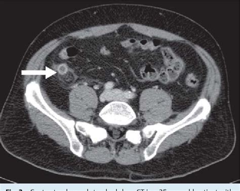 Figure 3 From Imaging Of Appendicitis In Adults Semantic Scholar
