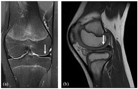 Clinical Considerations Of Anatomy And Magnetic Resonance Imaging In Pediatric Meniscus Tear