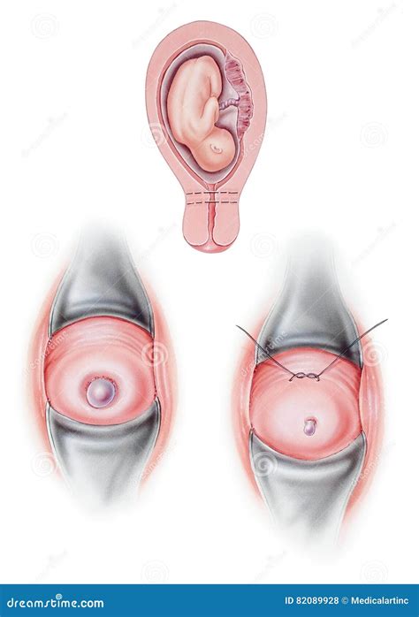 cervix cerclage cervical illustration stock illustration du reproduction 82089928