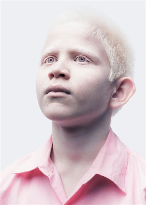 Pin By Kachy On Albinism Albinism Albino Aesthetic People