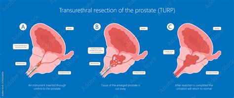 Transurethral Resection Of The Prostate Stricture Urine Bladder Digital