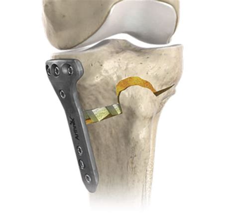 Knee Joint Preservation Surgery Including High Tibial Osteotomy