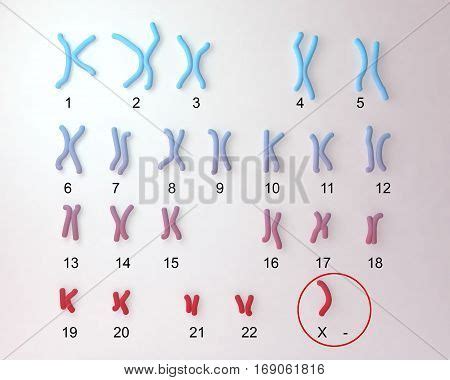 Turner S Syndrome Image Photo Free Trial Bigstock
