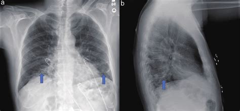 Posteroanterior A And Lateral B Chest X Ray Demonstrating Patchy