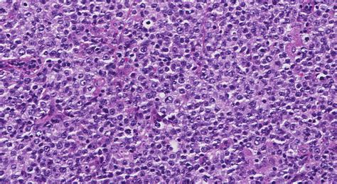 Non Hodgkin Lymphoma Mypathologyreportca