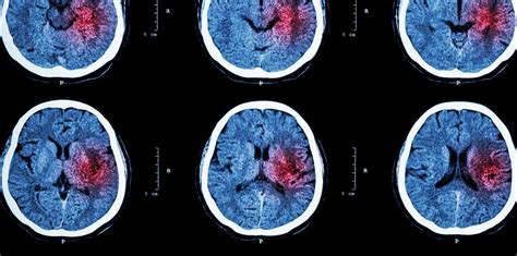 Cerebral Hemorrhage Treatment In Miami Florida By Neurosurgeon