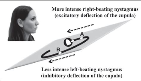 Pdf Nystagmus Intensity And Direction In Bow And Lean Test An Aid To