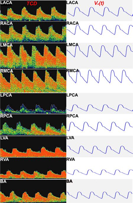 All nine TCD waves of a patient (left); estimated ...