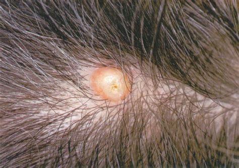 Boils On Scalp Causes Treatment And Prevention For Boils On Your