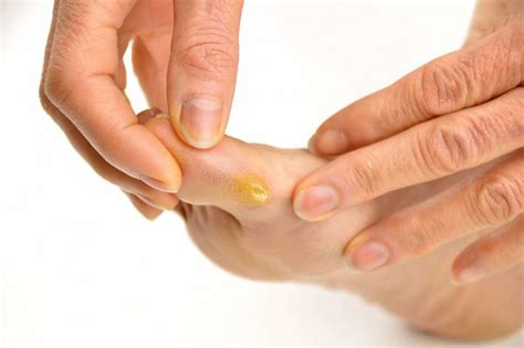 Can I Remove Minor Calluses From My Feet Jaws Podiatry