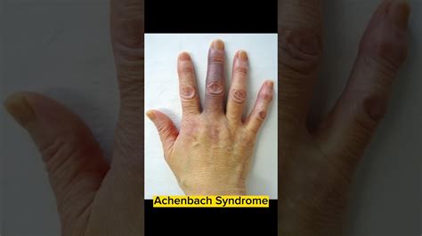 Achenbach Syndrome Proxysmal Finger Haematoma Doctor Dermatology