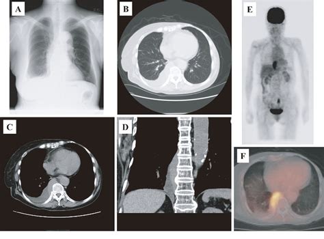 Figure 1 From Primary Marginal Zone Lymphoma In The Posterior