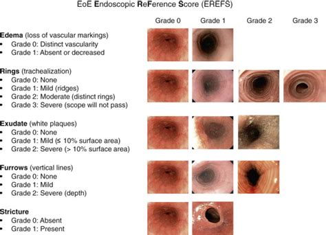 Eosinophilic Esophagitis Clinical Manifestations Diagnosis And Irasutoya