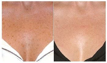 As you can see, this is not a whitening product, but it does clearly reduce the appearance of age spots. Meladerm Canada - Common Questions about Liver Spots