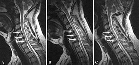 Missed Cervical Disc Bulges Diagnosed With Kinematic Magnetic Resonance