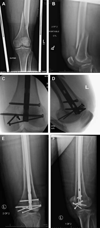 Management Of Distal Femur Fractures In Adults Orthopedic Clinics