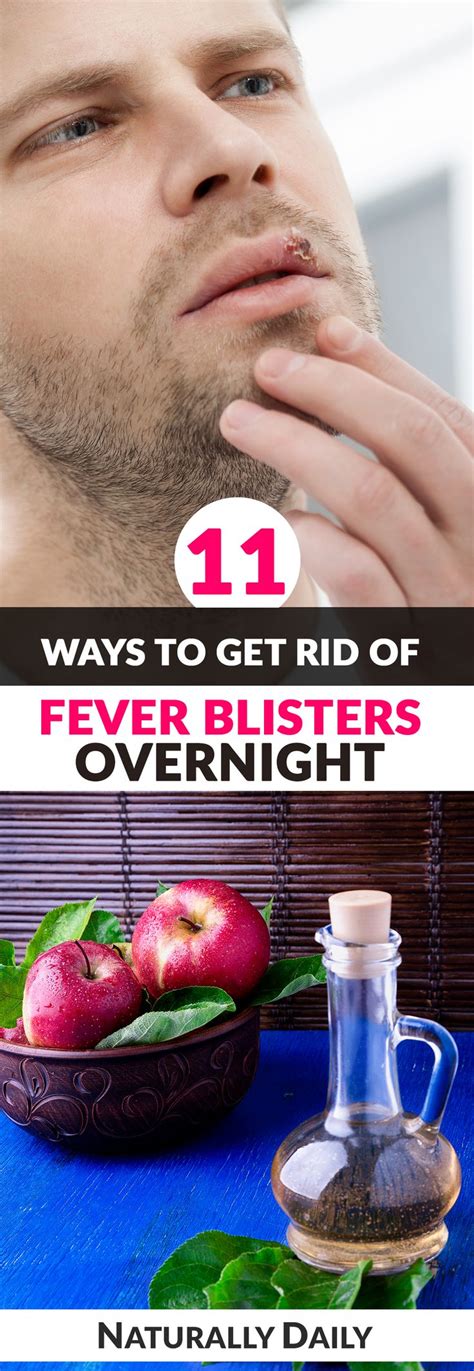 11 Ways To Get Rid Of Fever Blisters Overnight Fever Blister Fever